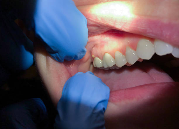 Best Emergency Dental Care for Sports Injuries in Crockett, TX